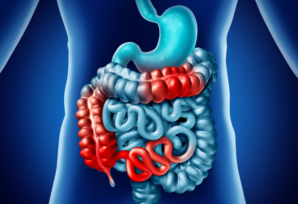 Understanding the Remission and Relapse Cycle in Crohn’s Disease ...